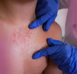 Impetigo Treatment