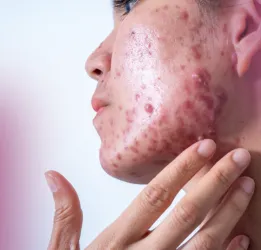 Acne Treatment