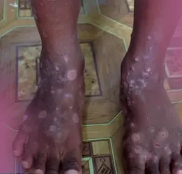 Yaws Treatment