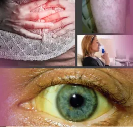 Q Fever Treatment