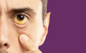 jaundice treatment