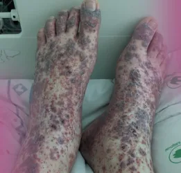 Vasculitis Treatment
