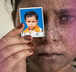 Xeroderma Pigmentosum (XP) Treatment
