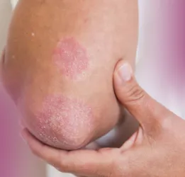 Jock Itch Treatment