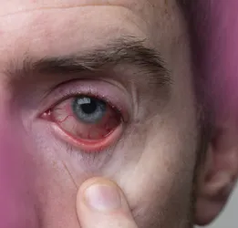 Uveitis Treatment