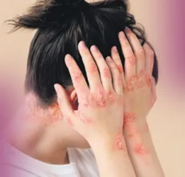 Psoriasis Treatment