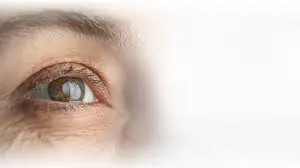 cataract