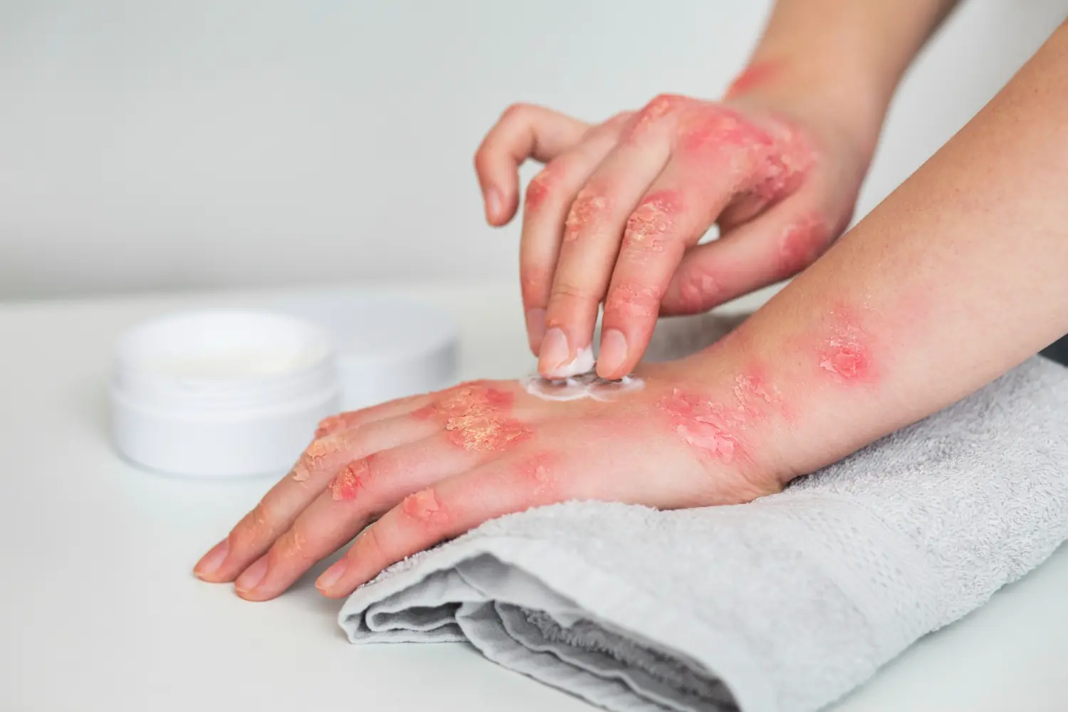 Burns Treatment