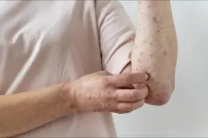 Measles Treatment