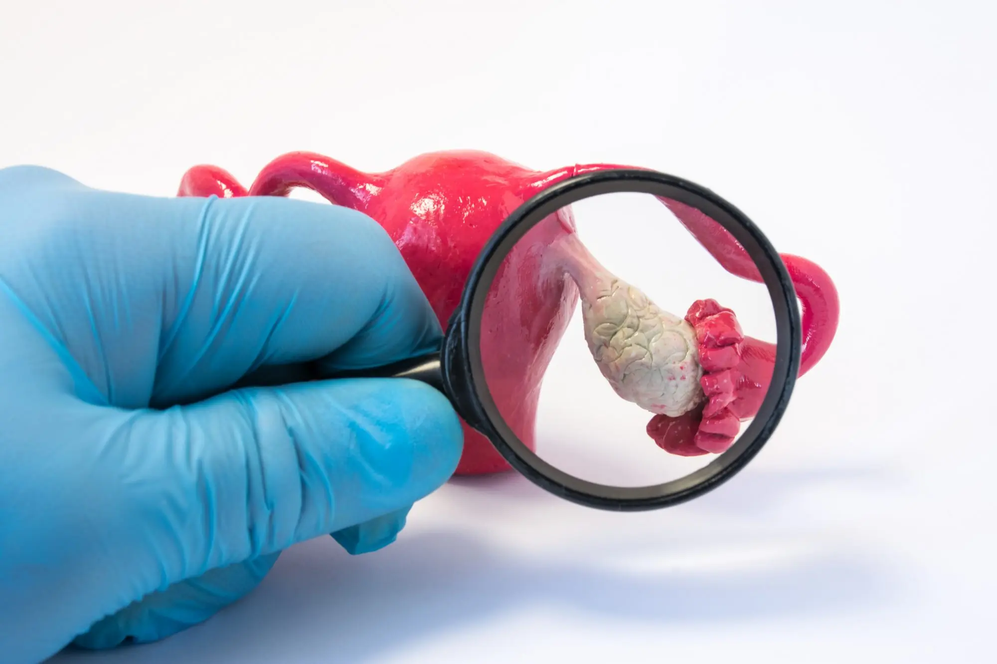 Polycystic Ovary Syndrome Treatment